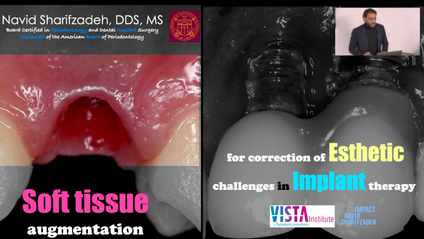Product image for Soft tissue augmentation for correction of esthetic challenges in implant therapy