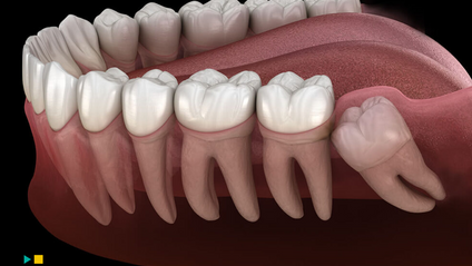 Product image for Gömülü Yirmi Yaş Dişlerinin Cerrahi Uygulamaları
