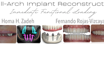 Product image for Full-Arch Implant Reconstruction Immediate Functional Loading