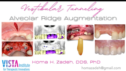 Product image for Vestibular Tunneling for Bone Augmentation