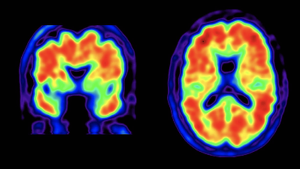 Product image for Chronic infection and the etiology of dementia