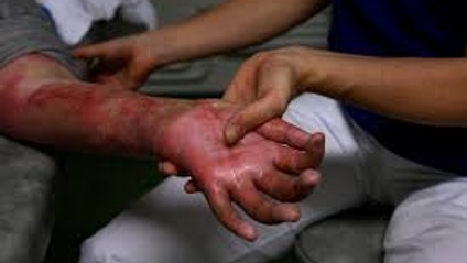 Product image for Burns & Scalding: Facts & Prevention