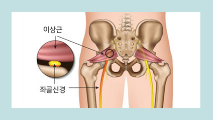 Product image for [재활의 정석] 이상근증후군