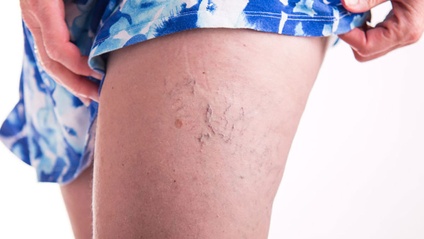 Product image for Sclerotherapy