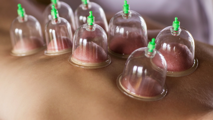 Product image for Cupping Therapy (6 CEUs)