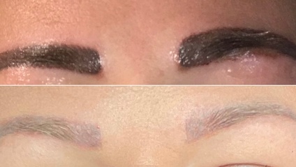 Product image for Saline Tattoo Removal