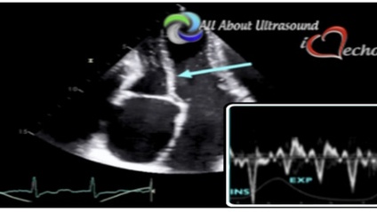 Product image for All About Echocardiography - Constrictive Pericarditis NON_CME