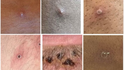 Product image for Monkey Pox - what is it? - 1 hour 