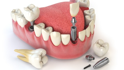 Product image for Tam Kapsamlı İmplant Üstü Protez Kursu
