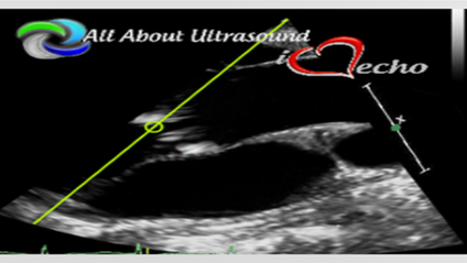 Product image for All About Echocardiography - Aortic Stenosis NON-CME