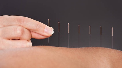 Product image for 50 Hour MSK Acupuncture (ONLINE)