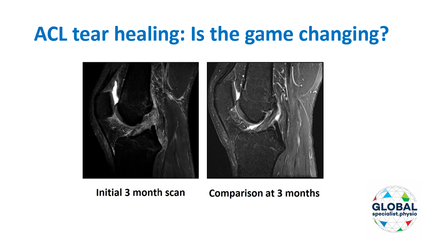 Product image for ACL tear healing without surgery: Is the game changing?