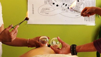 Product image for Fire Cupping