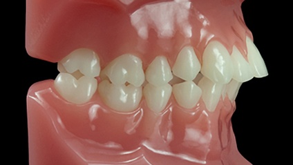 Product image for Class II Correction and Treatment of OSA 2021