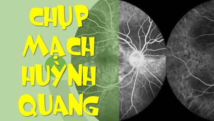 Product image for Chụp mạch huỳnh quang