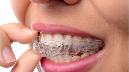 Product image for Aesthetic Orthodontics/Adult Orthodontics Lingual Braces and Clear Aligners Therapy 2021