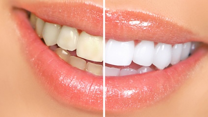 Product image for Teeth Whitening and Teeth Bling Class with KIT