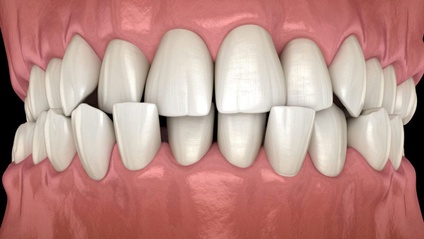 Product image for Early Treatment of Crossbites
