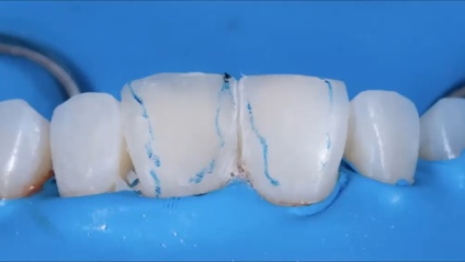 Product image for Mastering Composite Artistry:  Tips and a Toolbox for Clinical Success