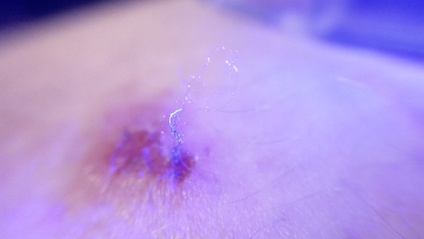 Product image for Introduction to Morgellons