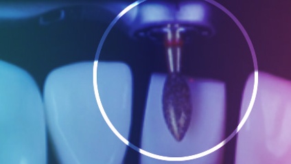 Product image for Minimally Invasive Ceramic Restorations: From Concept To Completion - Virtual Course