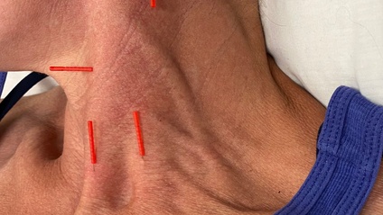 Product image for Dry Needling 1