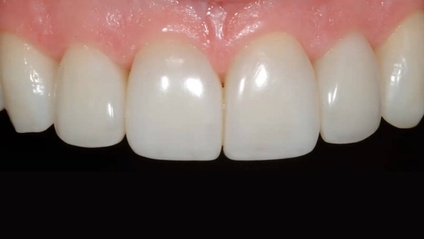 Product image for Ultimate Esthetics with Composite: