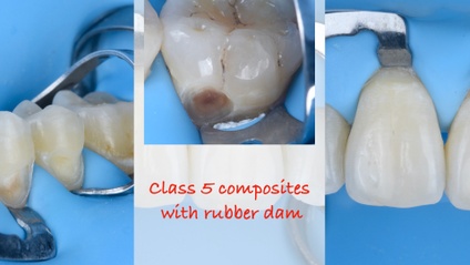 Product image for CLASS 5 COMPOSITES WITH RUBBER DAM
