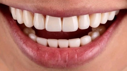 Product image for Full Mouth Reconstruction with Composite Resin