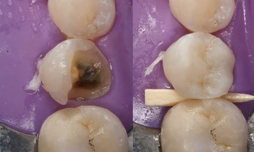 Product image for Direct Posterior Composites: Efficiency and Esthetics