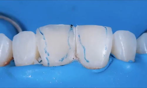 Product image for Mastering Composite Artistry:  Tips and a Toolbox for Clinical Success