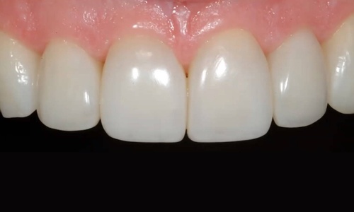 Product image for Ultimate Esthetics with Composite:
