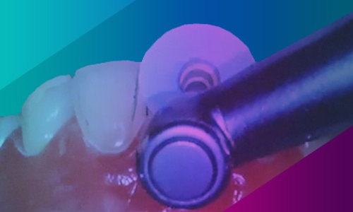Product image for Practical Tips Utilizing Composite Resin in the Everyday Practice - Virtual Course