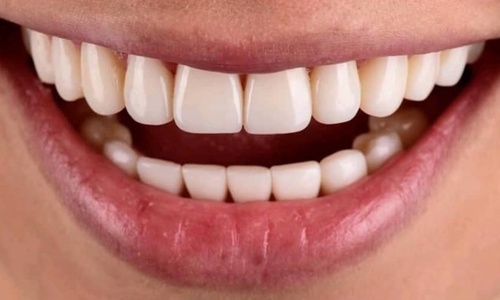 Product image for Full Mouth Reconstruction with Composite Resin