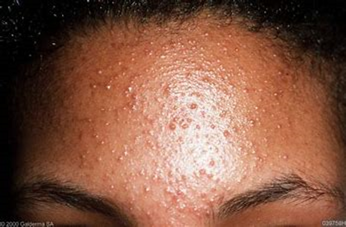 An Esthetician's Guide to Treating Fungal Folliculitis | The Skin