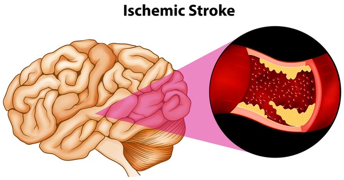 Acute Ischemic Stroke (2 CEUs) | Nurse Continuing Ed